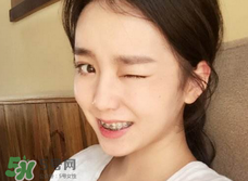 帶牙套會(huì)影響嘴型嗎?帶牙套會(huì)改變嘴型嗎? 帶牙套會(huì)影響嘴型嗎?帶牙套會(huì)改變嘴型嗎?