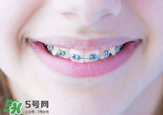 帶牙套的好處和壞處_帶牙套有什么后遺癥 帶牙套的好處和壞處_帶牙套有什么后遺癥