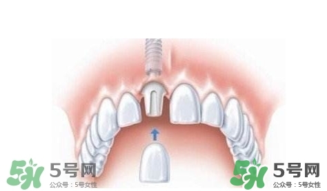 牙周炎能種植牙嗎？牙周炎能不能種植牙