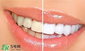 牙周炎好治嗎？牙周炎好不好治