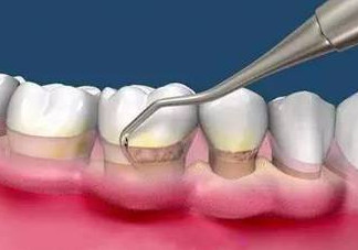 牙周炎怎么治療效果最好？牙周炎怎么治療小偏方