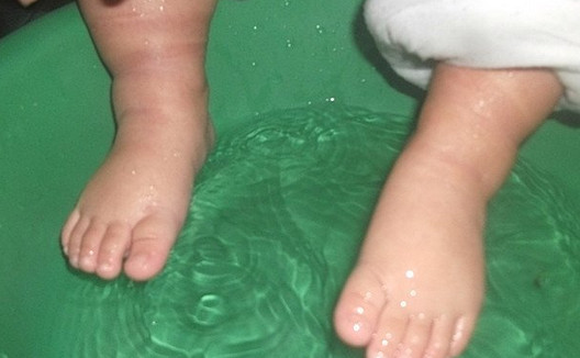 哪些人不適合泡腳？哪些人不宜泡腳