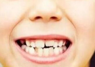 牙縫越來越大怎么辦？牙縫越來越大怎么修復