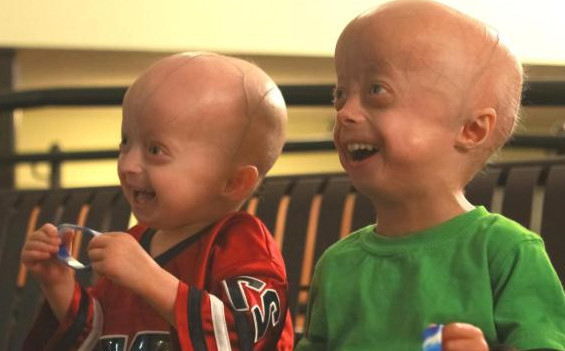 什么是早衰癥？早衰癥初期癥狀