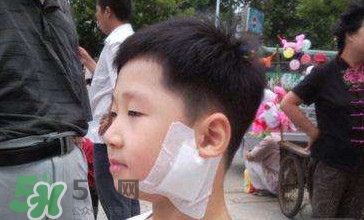 流行性腮腺炎怎么預(yù)防？流行性腮腺炎如何有效預(yù)防