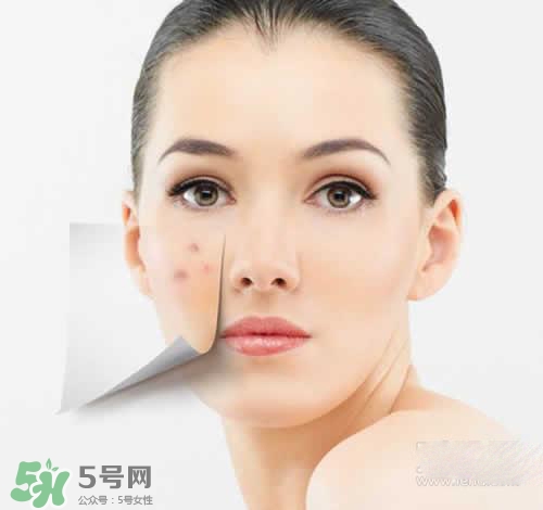 黑色痘印多久會(huì)消失？黑色痘印消失時(shí)間