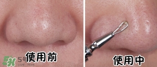 cosmos隱藏式青春痘棒粉刺針怎么樣？cosmos粉刺針多少錢？