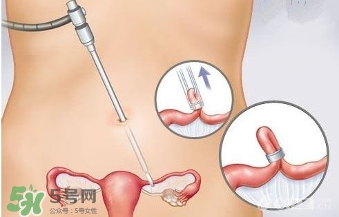 女人怎樣避孕最安全？對女人最好的避孕方法