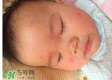 嬰兒蚊子咬了怎么消腫？嬰兒蚊子咬了怎么消腫止癢最快？