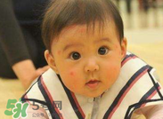 嬰兒蚊子咬了怎么消腫？嬰兒蚊子咬了怎么消腫止癢最快？