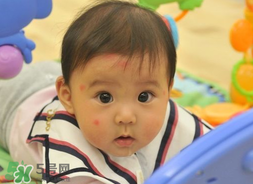 嬰兒被蚊子咬了如何去紅點？被蚊子咬后紅點如何去除？