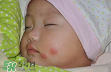 嬰兒被蚊子咬了如何去紅點？被蚊子咬后紅點如何去除？