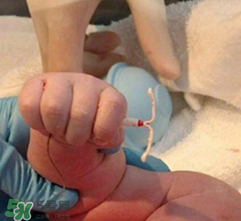 新生兒手握避孕環(huán)出生是怎么回事？出生后健康嗎？