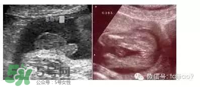 B超單數(shù)據(jù)怎么看男女？B超單看男女準(zhǔn)嗎？