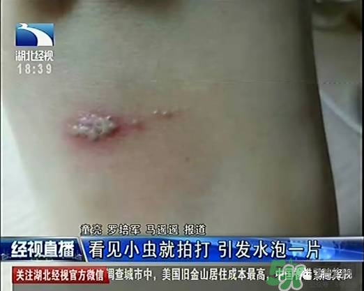 隱翅蟲有毒嗎？隱翅蟲會(huì)毀容嗎？