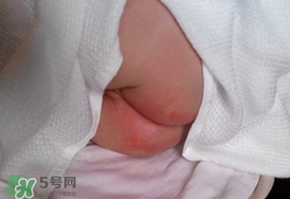 尿布疹怎么辦？寶寶尿布疹擦什么藥好？