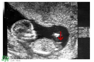 NT超圖全景看寶寶性別，親證有效的B超自測(cè)男女方法