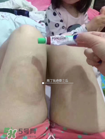 日本msd祛疤膏怎么樣？日本msd祛疤膏有用嗎？