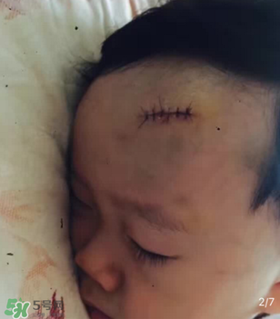 日本msd祛疤膏是抗生素嗎？日本msd祛疤膏是不是抗生素？