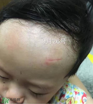 日本msd祛疤膏是抗生素嗎？日本msd祛疤膏是不是抗生素？