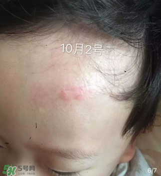 日本msd祛疤膏是抗生素嗎？日本msd祛疤膏是不是抗生素？