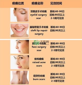 kelo cote疤痕凝膠效果好嗎？芭克硅膠軟膏效果怎樣