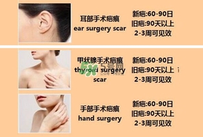 kelo cote疤痕凝膠效果好嗎？芭克硅膠軟膏效果怎樣