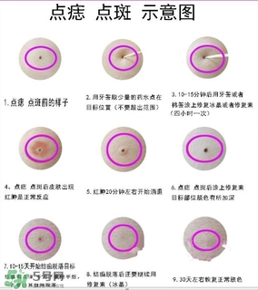 藥水點痣和激光點痣哪個好？各有什么優(yōu)缺點