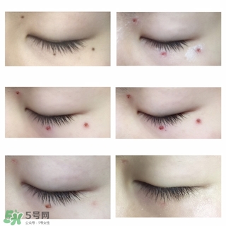 藥水點痣和激光點痣哪個好？各有什么優(yōu)缺點