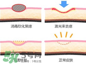 藥水點痣和激光點痣哪個好？各有什么優(yōu)缺點