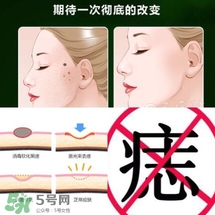 藥水點痣和激光點痣哪個好？各有什么優(yōu)缺點