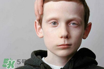 面癱是什么導(dǎo)致的？面癱多久徹底恢復(fù)正常