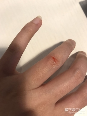 液體創(chuàng)可貼防水嗎？液體創(chuàng)可貼防水嗎透氣嗎？