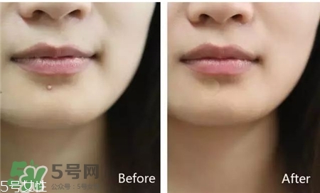 樂膚潔的痘痘貼好用么?樂膚潔凈痘貼怎么樣? 樂膚潔的痘痘貼好用么?樂膚潔凈痘貼怎么樣?