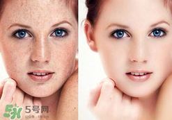 茄子皮敷臉可以祛斑嗎？茄子皮祛斑正確方法