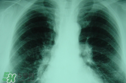 塵肺病吃什么藥能清肺？塵肺病國家有什么政策