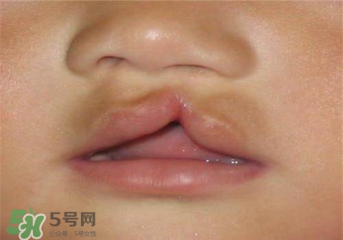 兔唇能檢查出來嗎？兔唇能完全修復嗎？