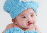 兔唇可以治嗎？兔唇修補術(shù)