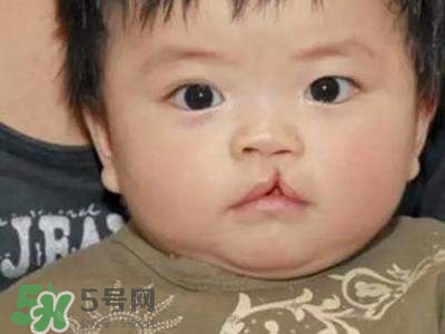 兔唇可以治嗎？兔唇修補(bǔ)術(shù)