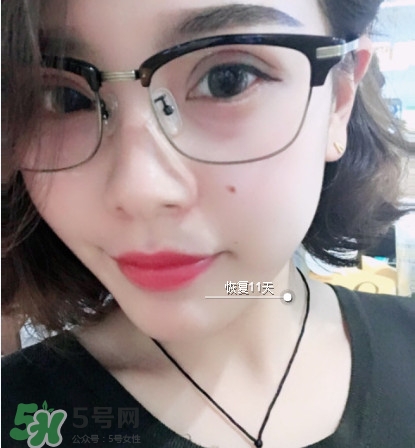 三點(diǎn)定位雙眼皮過程圖 做三點(diǎn)定位雙眼皮心得