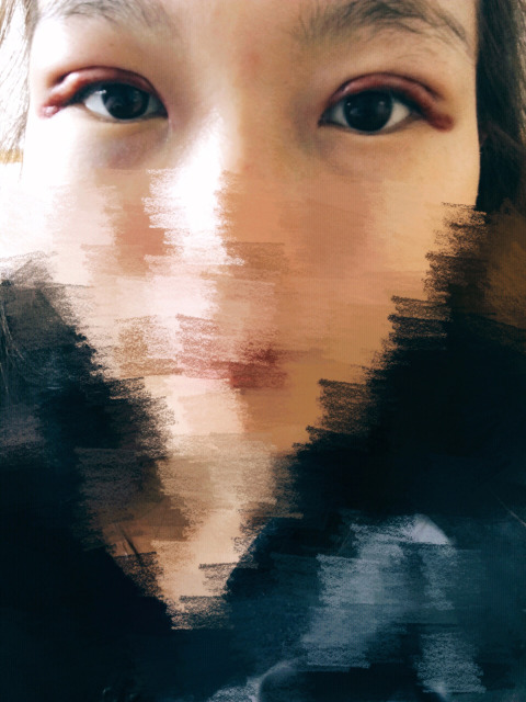 三點定位雙眼皮永久嗎 三點定位雙眼皮恢復(fù)過程圖片 三點定位雙眼皮永久嗎 三點定位雙眼皮恢復(fù)過程圖片