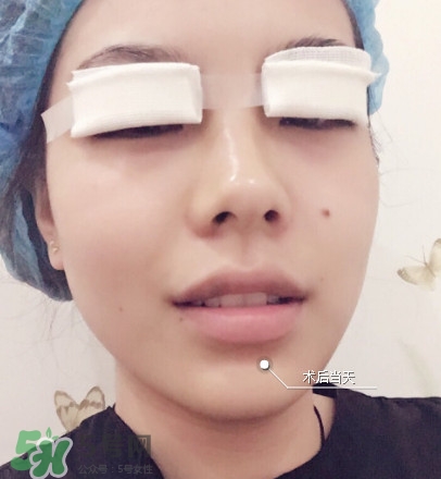 三點(diǎn)定位雙眼皮過程圖 做三點(diǎn)定位雙眼皮心得