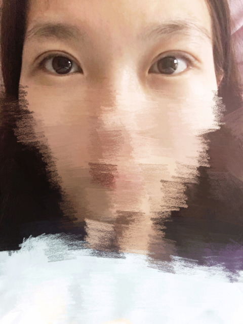 三點定位雙眼皮永久嗎 三點定位雙眼皮恢復(fù)過程圖片 三點定位雙眼皮永久嗎 三點定位雙眼皮恢復(fù)過程圖片