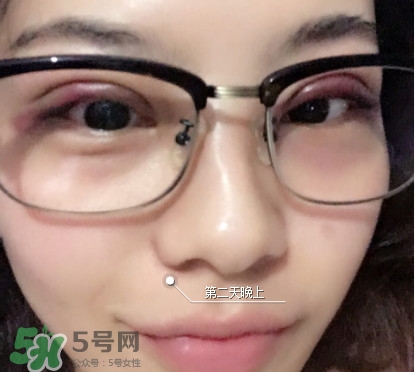 三點(diǎn)定位雙眼皮過程圖 做三點(diǎn)定位雙眼皮心得