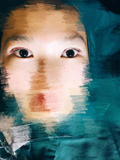 三點定位雙眼皮永久嗎 三點定位雙眼皮恢復(fù)過程圖片 三點定位雙眼皮永久嗎 三點定位雙眼皮恢復(fù)過程圖片