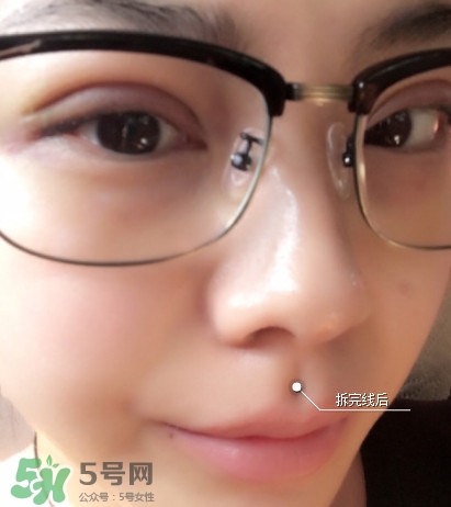 三點(diǎn)定位雙眼皮過程圖 做三點(diǎn)定位雙眼皮心得