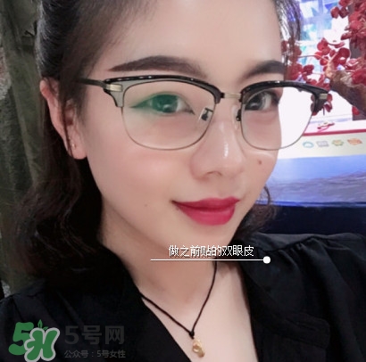 三點(diǎn)定位雙眼皮過程圖 做三點(diǎn)定位雙眼皮心得