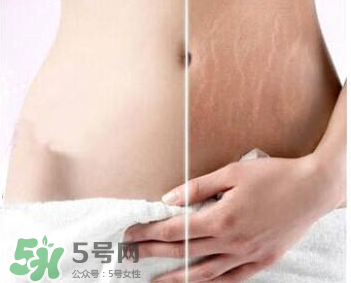 妊娠紋怎么長在大腿上了？妊娠紋會不會長在大腿上？