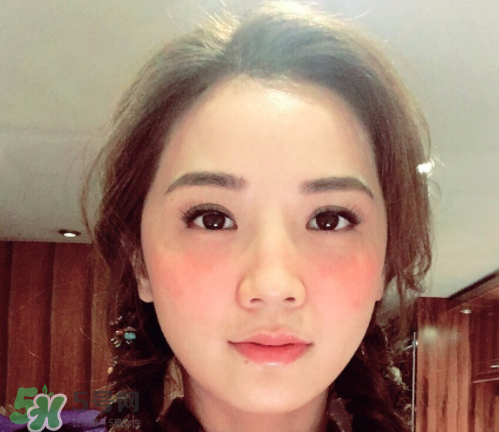 夏天可以點(diǎn)痣嗎？夏天點(diǎn)痣后要注意什么？