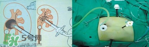 腎結(jié)石有什么癥狀？腎結(jié)石原因